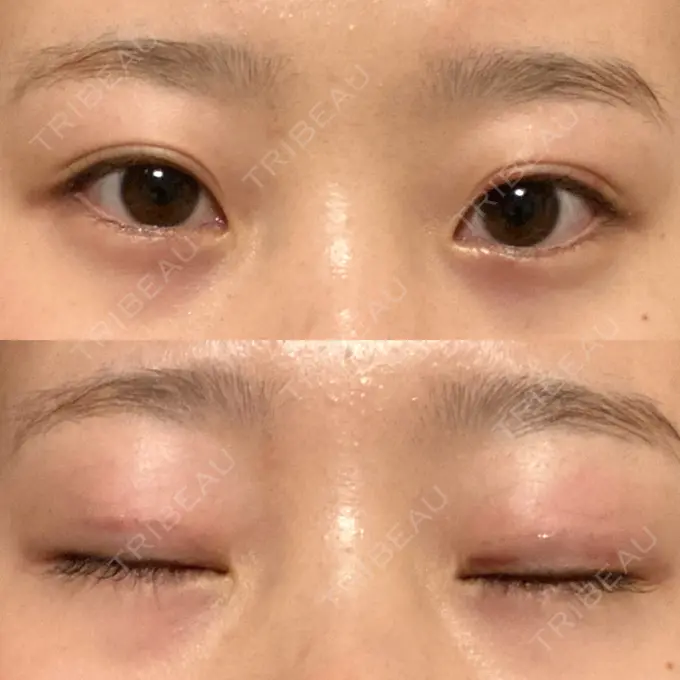 二重埋没 大西皮フ科形成外科医院 滋賀大津石山院 DAY 12 メイン用