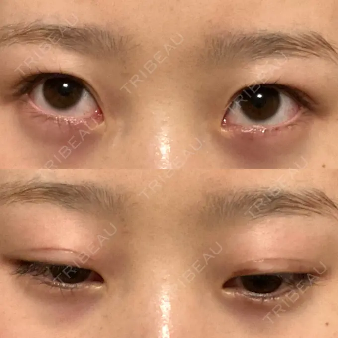 二重埋没 大西皮フ科形成外科医院 滋賀大津石山院 DAY 12 メイン用