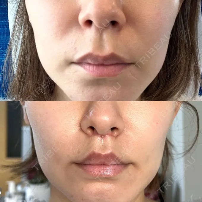 人中短縮 新宿ラクル美容外科クリニック 新宿院 DAY 29 メイン用