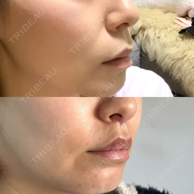 人中短縮 新宿ラクル美容外科クリニック 新宿院 DAY 29 メイン用