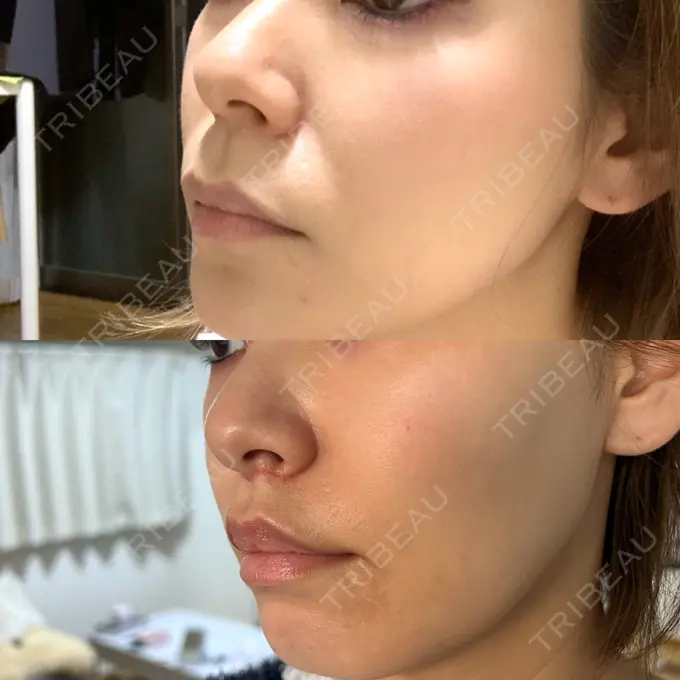 人中短縮 新宿ラクル美容外科クリニック 新宿院 DAY 29 メイン用