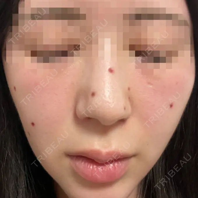 ほくろ・いぼ切除（肌） エースクリニック 大阪梅田HEPナビオ院 DAY 14 メイン用