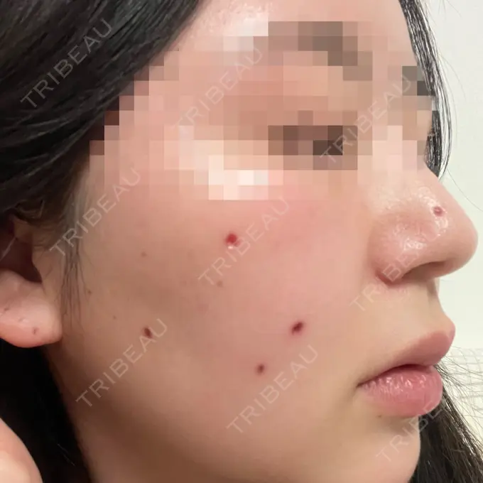 ほくろ・いぼ切除（肌） エースクリニック 大阪梅田HEPナビオ院 DAY 14 メイン用