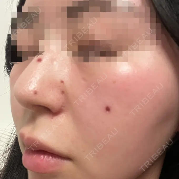 ほくろ・いぼ切除（肌） エースクリニック 大阪梅田HEPナビオ院 DAY 14 メイン用