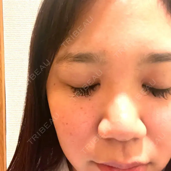 ヴェルヴェットスキン 銀座美容外科クリニック 銀座院 AFTER メイン用