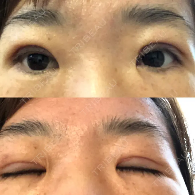 眼瞼下垂（切開） 滋賀美容皮膚科クリニック AFTER メイン用