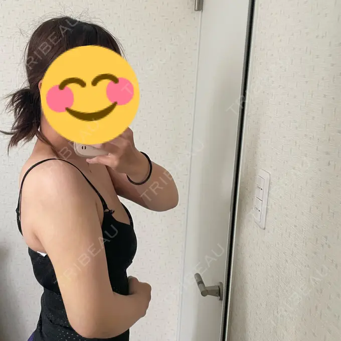 脂肪吸引（二の腕） / 脂肪吸引（肩） / ボトックス（肩） / ボトックス（首） Mods Clinic（モッズクリニック） 東京院 DAY 10 メイン用