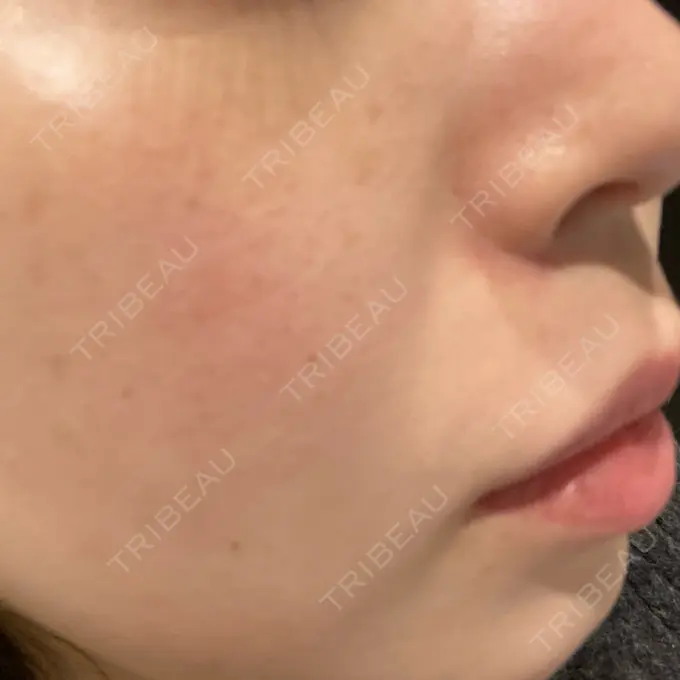 光治療（フォトフェイシャルなど） 渋谷美容外科クリニック 新橋院 DAY 0 メイン用