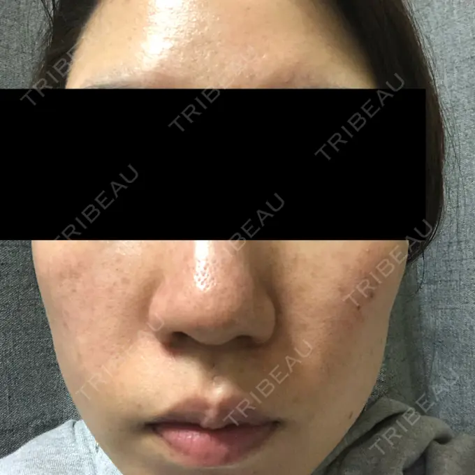 シミ取りレーザー フローラクリニック AFTER メイン用