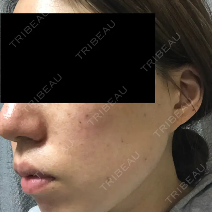 シミ取りレーザー フローラクリニック DAY 7 メイン用