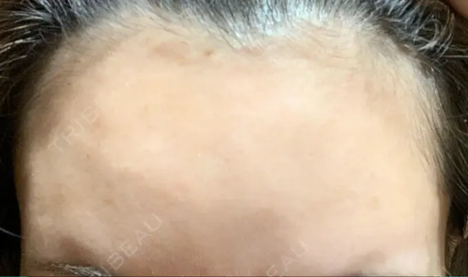 ボトックス（肩） / ボトックス（額） TCB東京中央美容外科 静岡院 DAY 1 メイン用