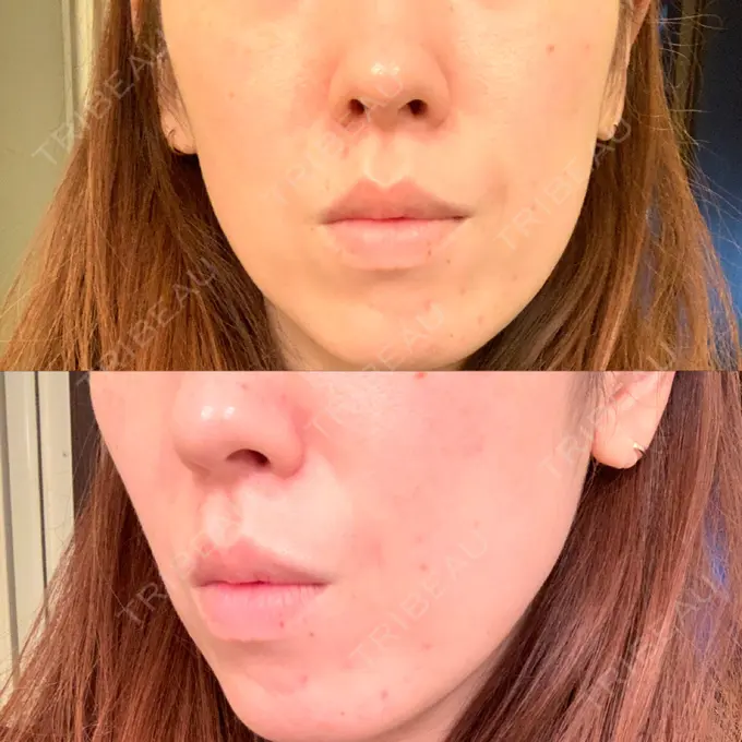 ピーリング（ハリ・ツヤ） ルラ美容クリニック 大宮院 / ルラスキンクリニック 大宮院 DAY 1 メイン用