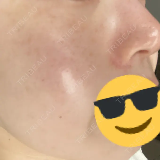 光治療（フォトフェイシャルなど） 渋谷美容外科クリニック 新橋院 DAY 2 メイン用