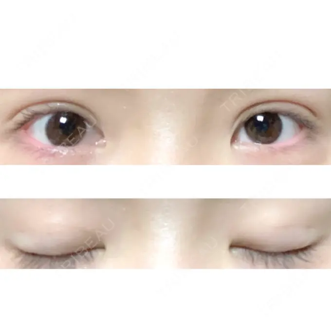 二重埋没 ハナビューティークリニック DAY 38 メイン用