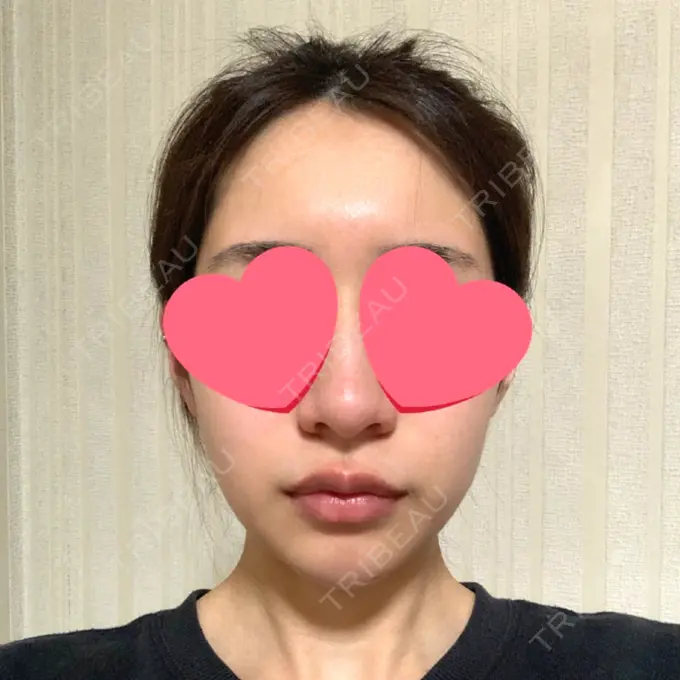 糸リフト / 脂肪吸引（顔） / メーラーファット除去 / ジョールファット除去 / ヒアルロン酸注入（頬） SEA CLINIC（シークリニック） AFTER メイン用