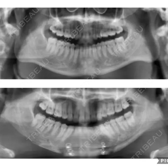 骨切り（あご） / 骨削り（エラ） リラ・クラニオフェイシャル・クリニック 大阪院 DAY 14 メイン用