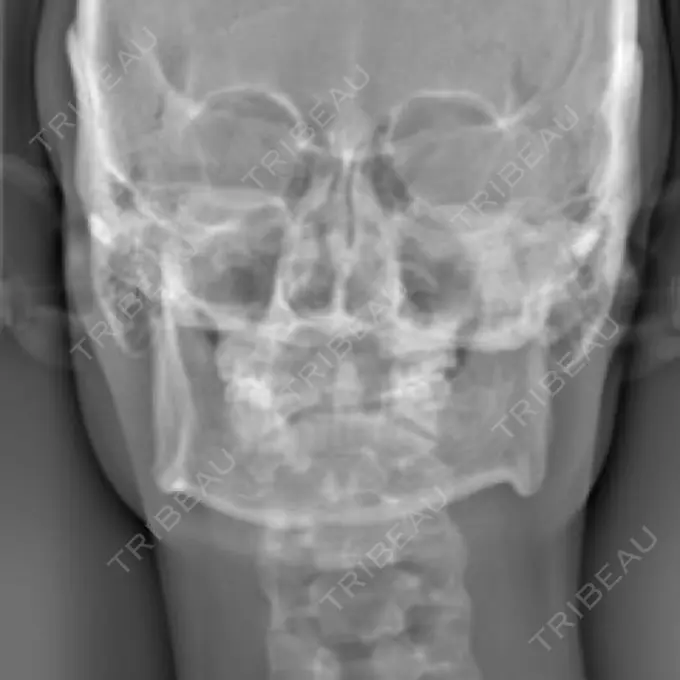 骨切り（あご） / 骨削り（エラ） リラ・クラニオフェイシャル・クリニック 大阪院 DAY 14 メイン用