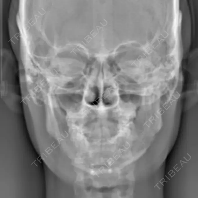 骨切り（あご） / 骨削り（エラ） リラ・クラニオフェイシャル・クリニック 大阪院 DAY 14 メイン用