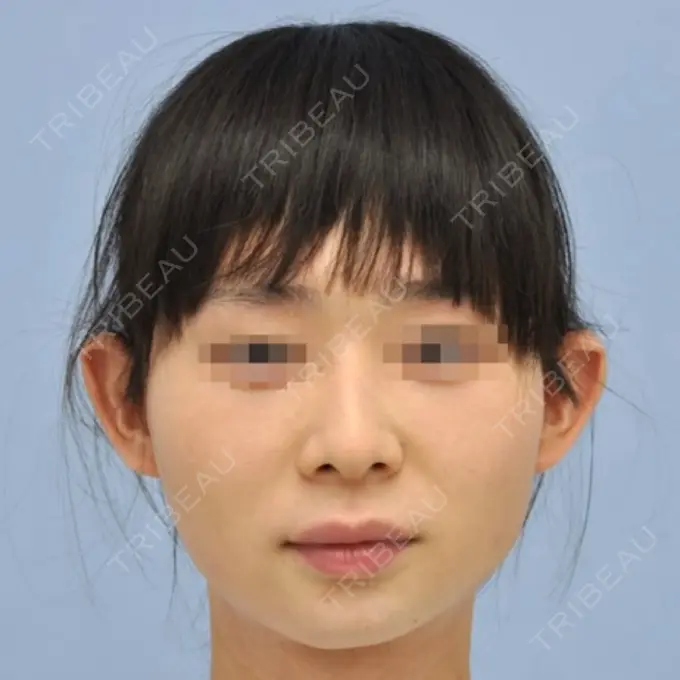 骨切り（あご） / 骨削り（エラ） リラ・クラニオフェイシャル・クリニック 大阪院 DAY 93 メイン用