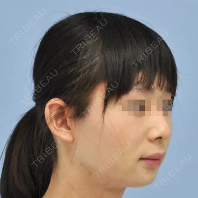 骨切り（あご） / 骨削り（エラ） リラ・クラニオフェイシャル・クリニック 大阪院 DAY 93 メイン用