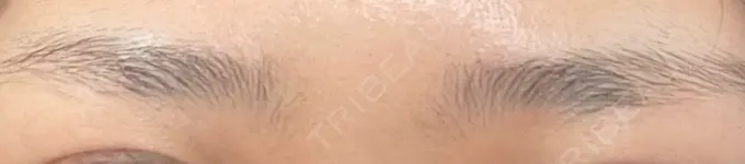 ボトックス（眉間） ルラ美容クリニック 池袋院 AFTER メイン用