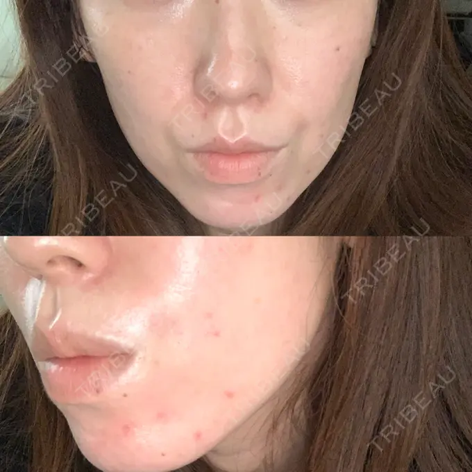 ピーリング（ハリ・ツヤ） ルラ美容クリニック 大宮院 / ルラスキンクリニック 大宮院 AFTER メイン用