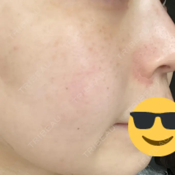 光治療（フォトフェイシャルなど） 渋谷美容外科クリニック 新橋院 DAY 4 メイン用