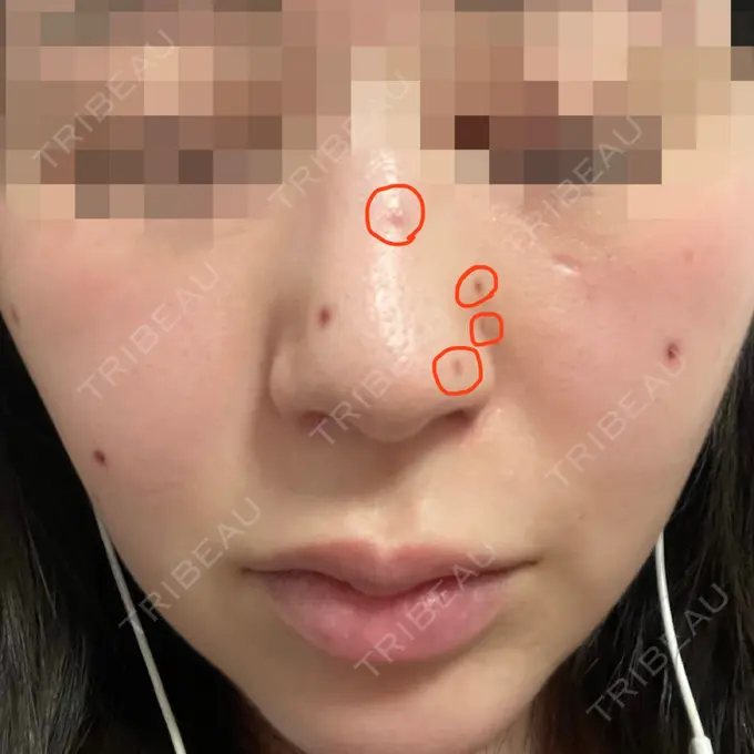 ほくろ・いぼ切除（肌） エースクリニック 大阪梅田HEPナビオ院 AFTER メイン用