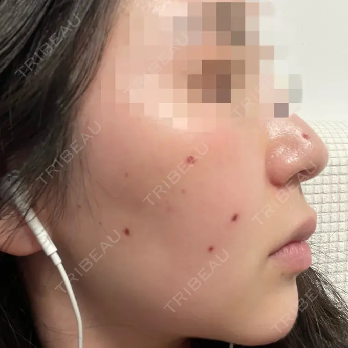 ほくろ・いぼ切除（肌） エースクリニック 大阪梅田HEPナビオ院 DAY 19 メイン用