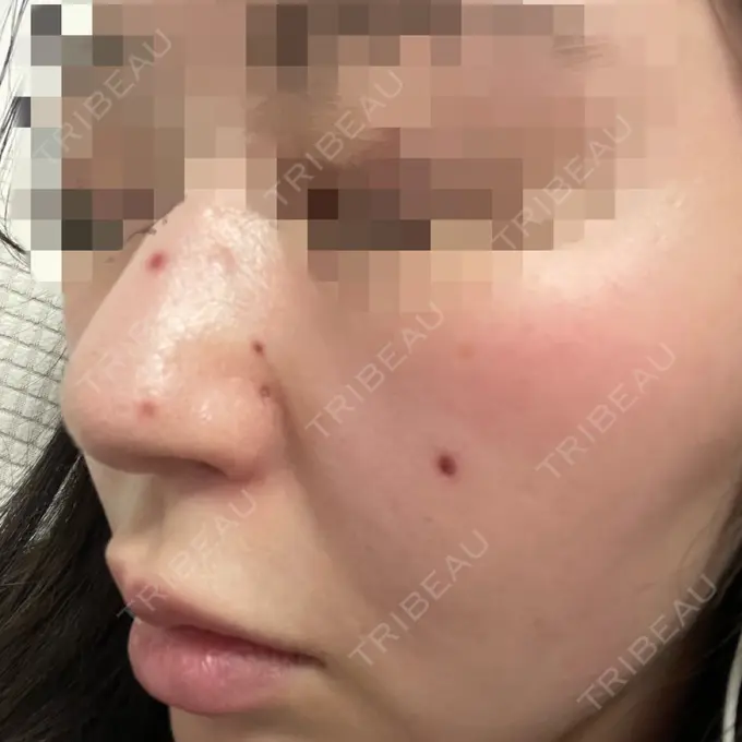 ほくろ・いぼ切除（肌） エースクリニック 大阪梅田HEPナビオ院 DAY 19 メイン用