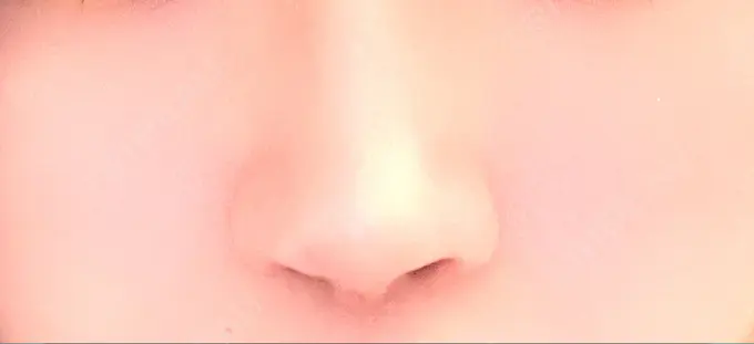 隆鼻術 / 鼻中隔延長（切開） / 鼻修正 / 鼻孔縁下降 / その他（鼻） みずほクリニック DAY 15 メイン用