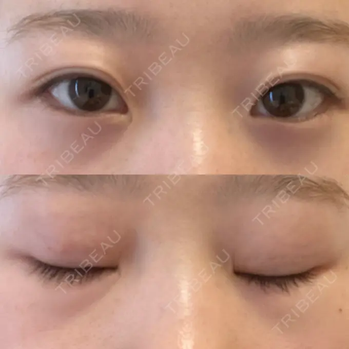 二重埋没 大西皮フ科形成外科医院 滋賀大津石山院 DAY 18 メイン用