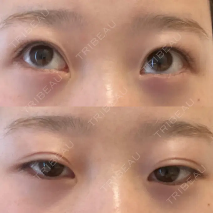 二重埋没 大西皮フ科形成外科医院 滋賀大津石山院 DAY 18 メイン用