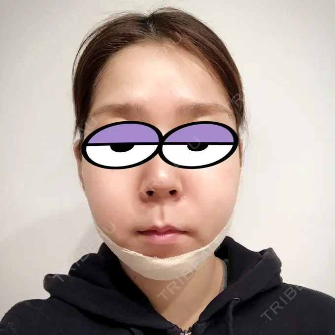 バッカルファット除去 / 脂肪吸引（顔） / ボトックス（エラ・小顔） THE PLAN（ザ・プラン）美容整形外科・皮膚科 DAY 3 メイン用