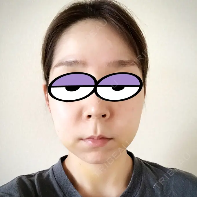 バッカルファット除去 / 脂肪吸引（顔） / ボトックス（エラ・小顔） THE PLAN（ザ・プラン）美容整形外科・皮膚科 DAY 5 メイン用