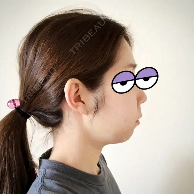 バッカルファット除去 / 脂肪吸引（顔） / ボトックス（エラ・小顔） THE PLAN（ザ・プラン）美容整形外科・皮膚科 DAY 5 メイン用