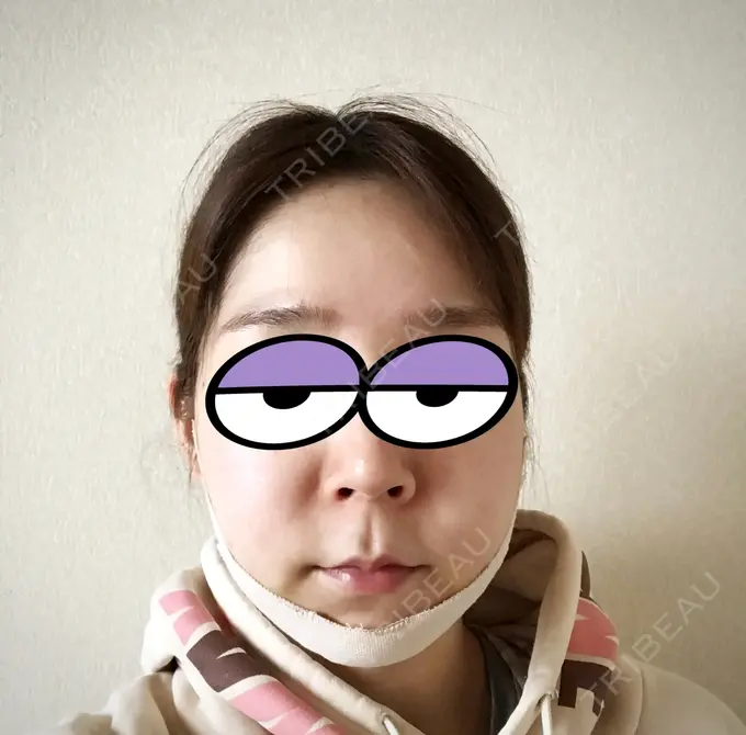 バッカルファット除去 / 脂肪吸引（顔） / ボトックス（エラ・小顔） THE PLAN（ザ・プラン）美容整形外科・皮膚科 DAY 4 メイン用