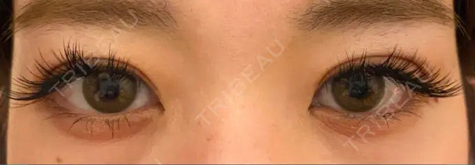 二重切開 / 上まぶたの脂肪取り 心斎橋コムロ美容外科クリニック AFTER メイン用