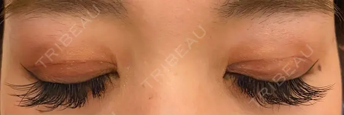 二重切開 / 上まぶたの脂肪取り 心斎橋コムロ美容外科クリニック DAY 98 メイン用