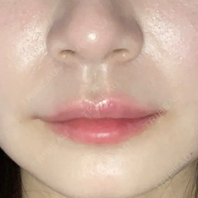 ヒアルロン酸注入（唇） / ボトックス（口角） id美容クリニック 銀座院 DAY 0 メイン用