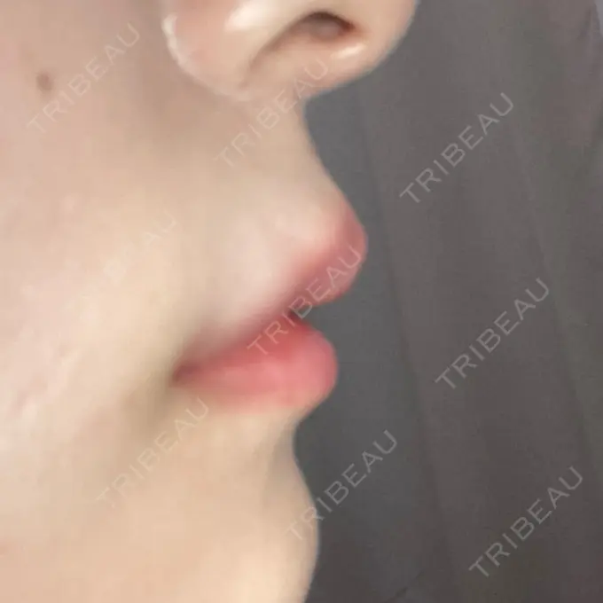 ヒアルロン酸注入（唇） / ボトックス（口角） id美容クリニック 銀座院 DAY 0 メイン用