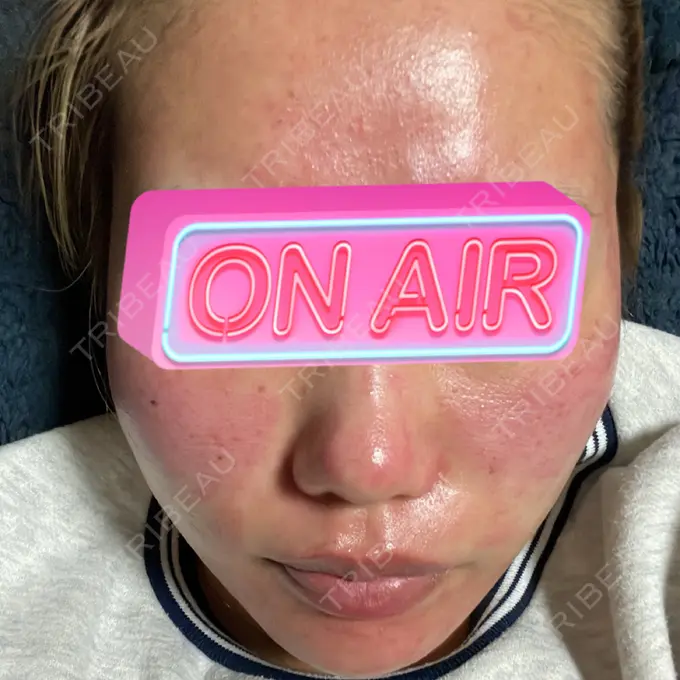 ヴェルヴェットスキン アリエル美容クリニック 大宮院 DAY 0 メイン用