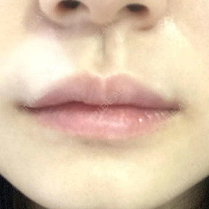 ヒアルロン酸注入（唇） / ボトックス（口角） id美容クリニック 銀座院 DAY 1 メイン用