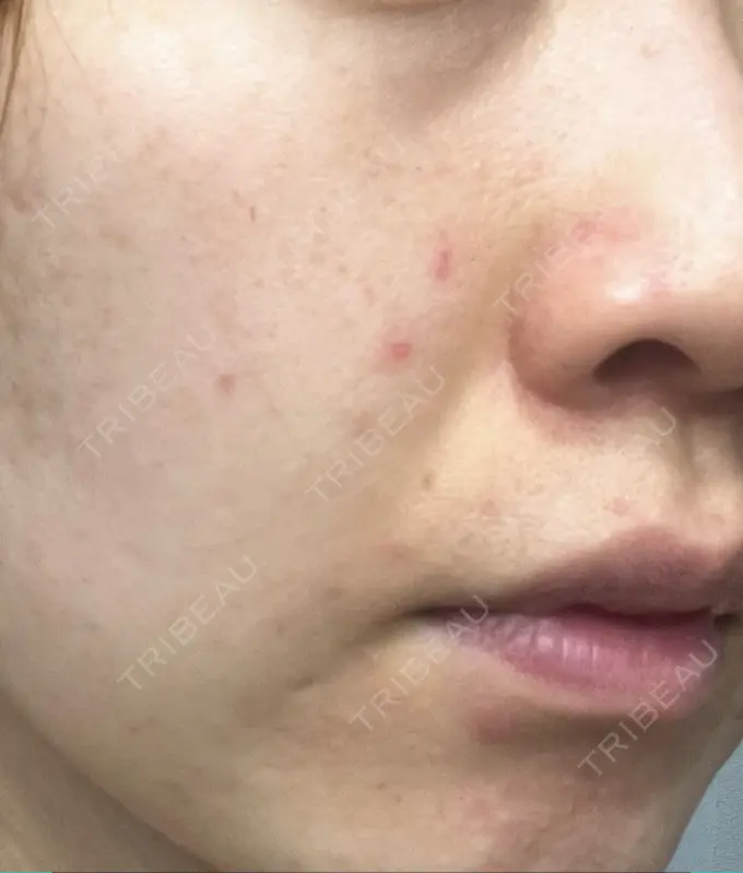 ハイフ（顔） STARS CLINIC DAY 14 メイン用