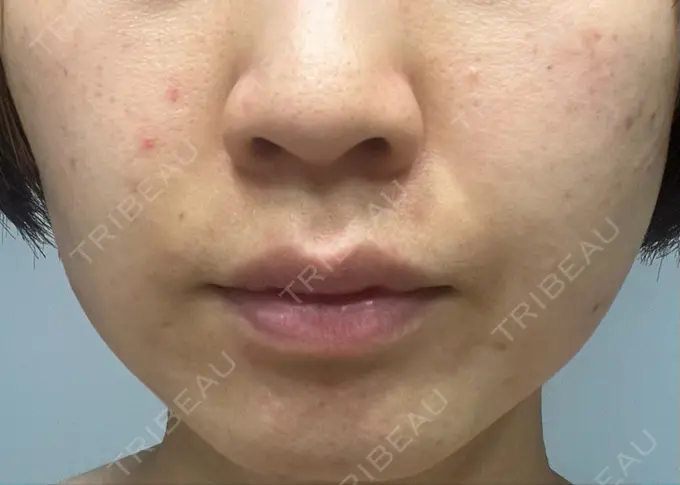 ハイフ（顔） STARS CLINIC DAY 14 メイン用