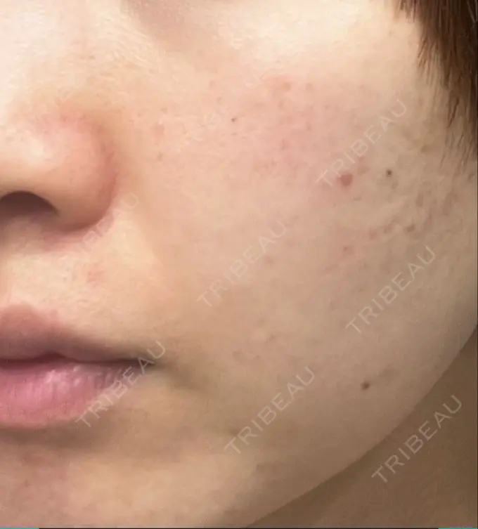 ハイフ（顔） STARS CLINIC DAY 14 メイン用