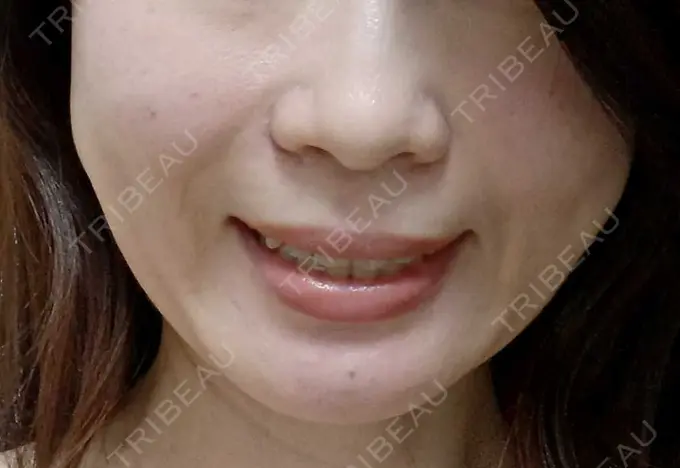 肌ヒアルロン酸注入（たるみ・シワ改善） 恵聖会クリニック 京橋院 DAY 1 メイン用