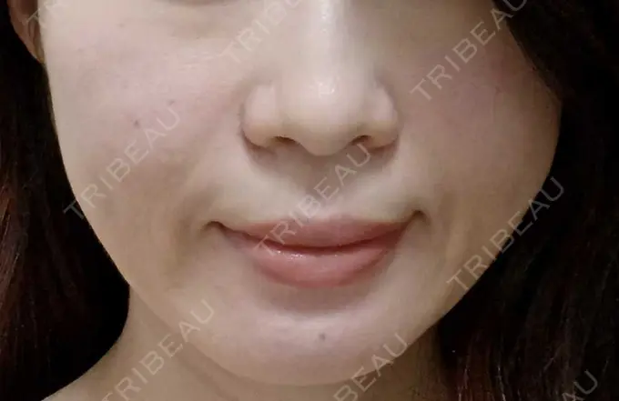 肌ヒアルロン酸注入（たるみ・シワ改善） 恵聖会クリニック 京橋院 DAY 1 メイン用