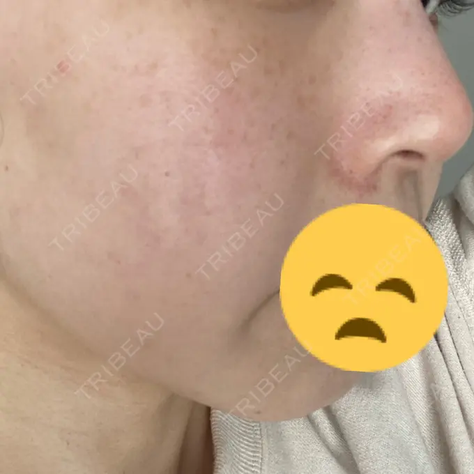 光治療（フォトフェイシャルなど） 渋谷美容外科クリニック 新橋院 AFTER メイン用