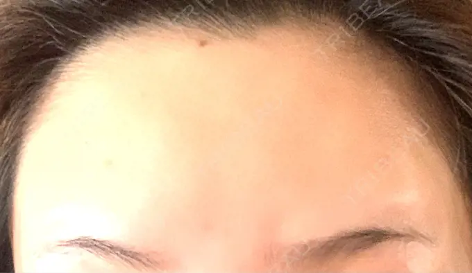 ボトックス（肩） / ボトックス（額） TCB東京中央美容外科 静岡院 DAY 8 メイン用